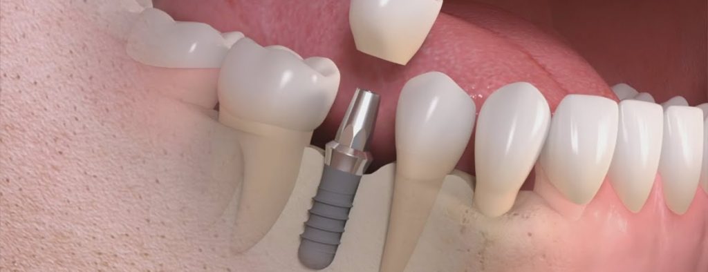 Implantodontia Borin Odontologia 9904